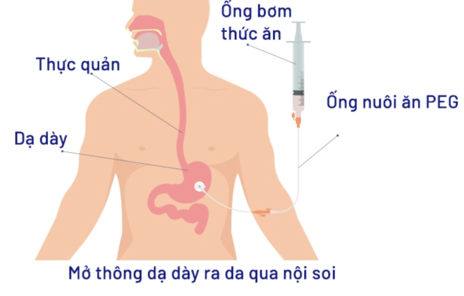 phương pháp mở thông dạ dày qua da