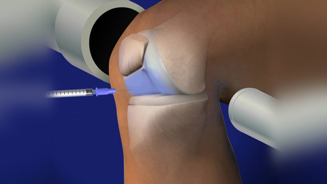 Tiêm chất nhờn vào khớp gối có tốt không? Có an toàn không? 1 Tiêm chất nhờn vào khớp gối