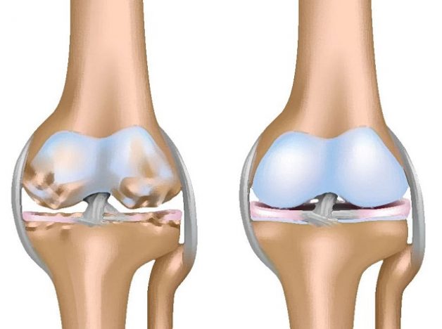 Tiêm chất nhờn vào khớp gối có tốt không? Có an toàn không? 4 Khô khớp