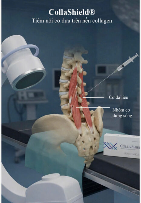 CollaShield - Tiêm Atelocollagen Điều Trị Đau Lưng Mãn Tính & Cơ Cạnh Sống 23 1784560429187 1860397381924080318 8849451064386434976 f3118fe51997e1e0818d14ed52716b48